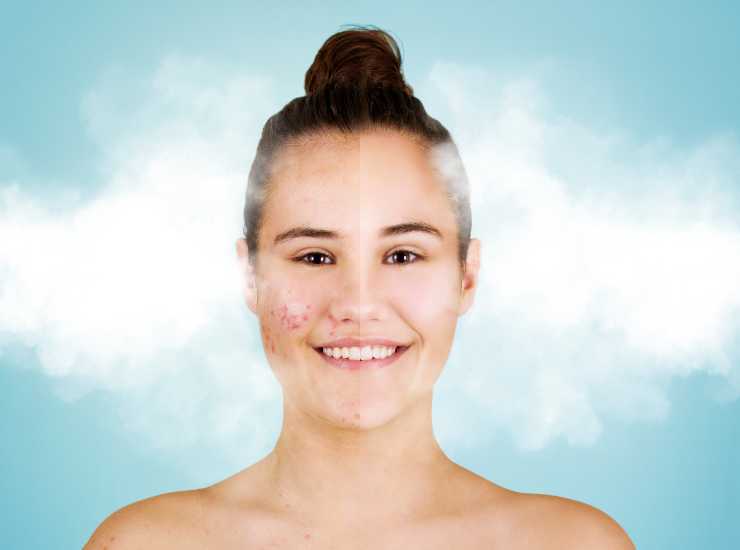 Facial cryotherapy