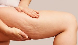 cellulite - modaeimmagine.it