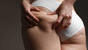 eliminare cellulite - modaeimmagine.it