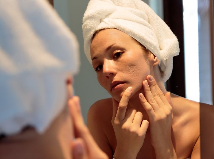 Ragazza con i segni dell'acne si guarda allo specchio 