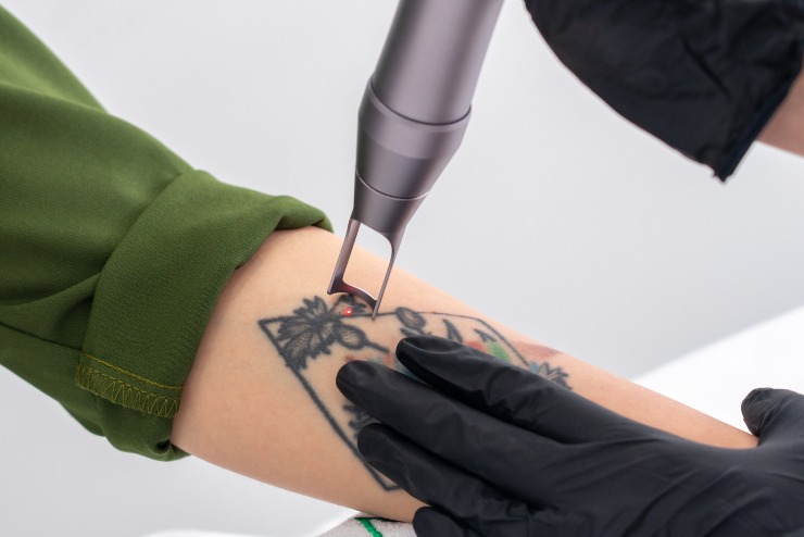 Eliminare tatuaggi con il laser